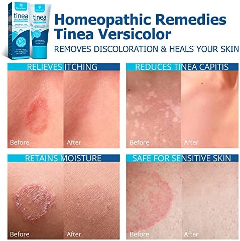 Roycederm Tinea Versicolor Treatment, Athletes Foot Treatment, Ringworm Treatment for Humans, for Tinea Versicolor & Pedis,Fast Healing Anti Fungal Skin Cream - Multi-Functional