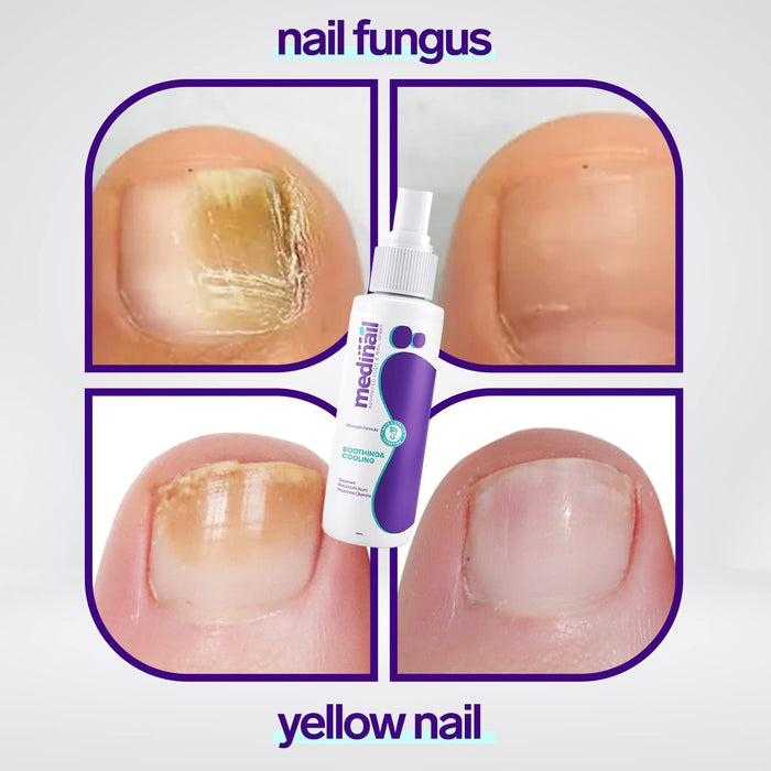 Medinail Nail Repair Spray - Advanced Foot and Nail Repair & Strengthener - Natural Nail Whitener for Yellow Nails - 3.38 Fl Oz (Pack of 1)