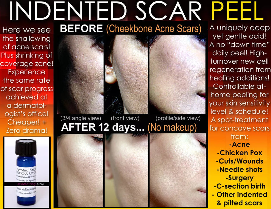 DEVOTEDTHINGS Indented Acne Scar Removal Peel Chicken Pox Ice pick Rolling Boxcar Scars